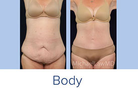 Body Contouring