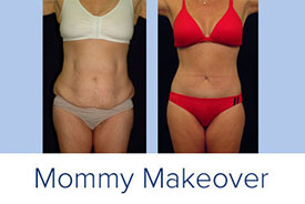 mommy makeover